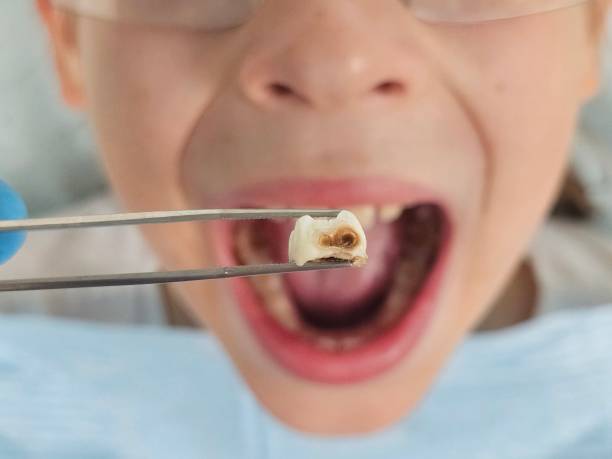 Best Emergency Wisdom Tooth Extraction in Somerville, TN